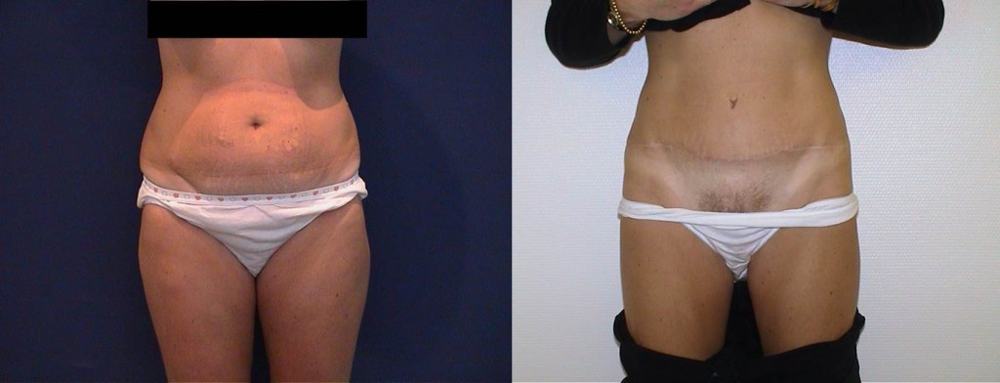 Photo Article Platysma 2 web