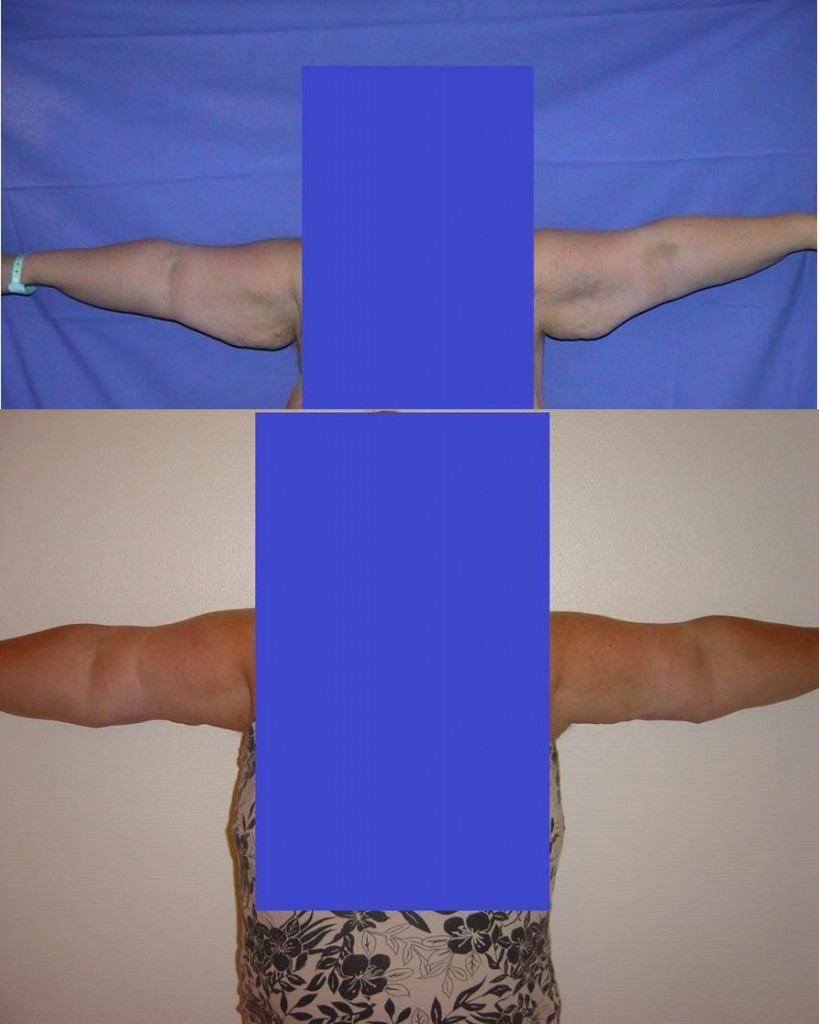 Fig 4 Schema PA + Lipo